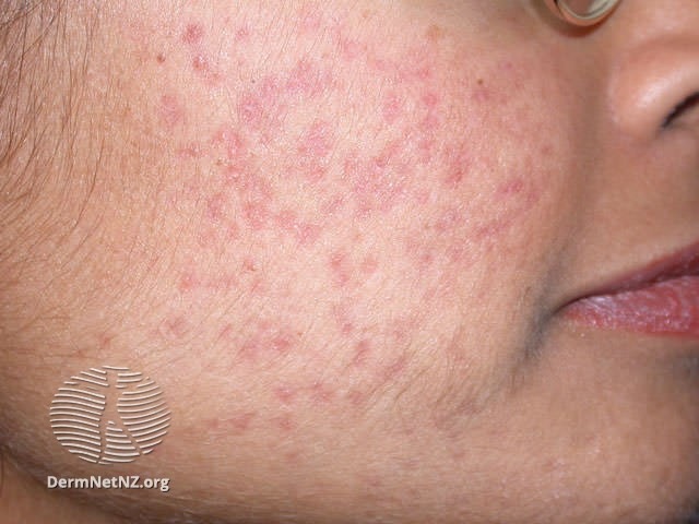 Post-Inflammatory Redness from Pimples