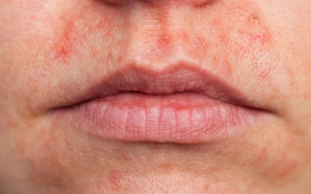 Perioral Dermatitis