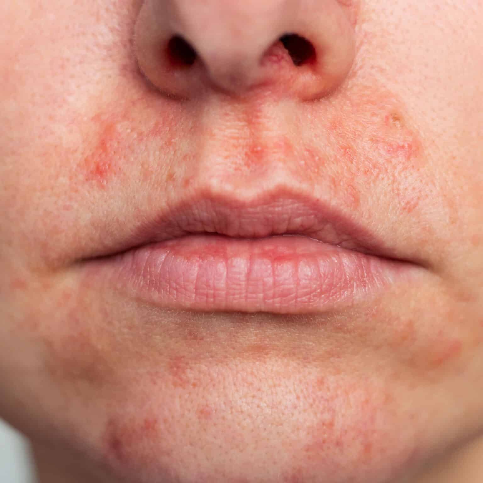 Perioral Dermatitis