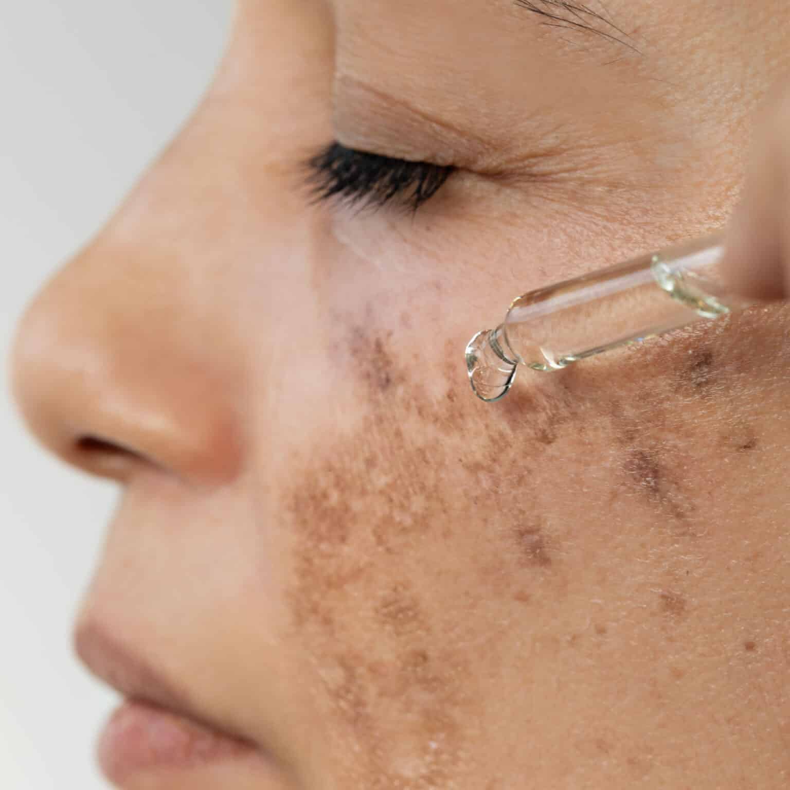 Facial Hyperpigmentation