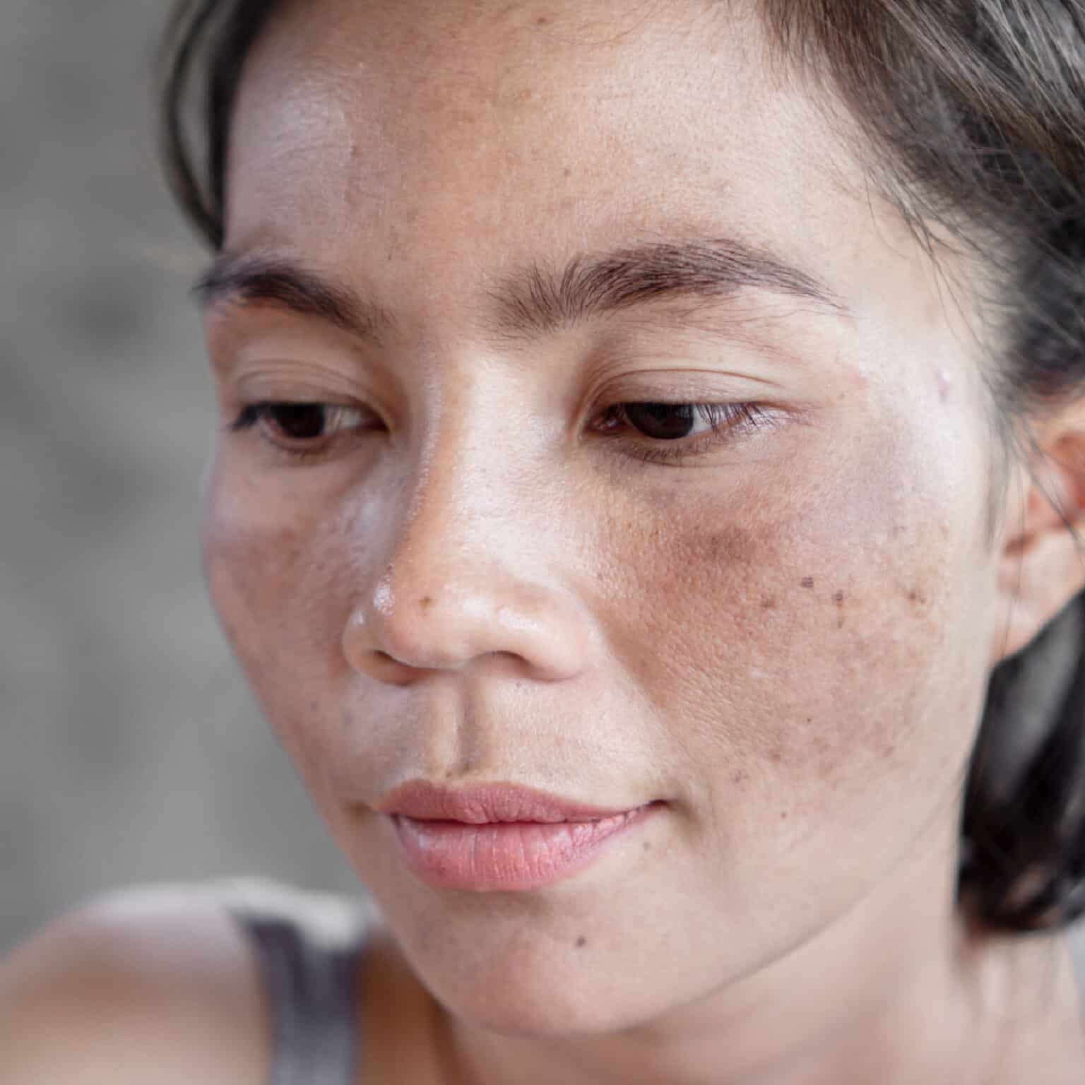 Dry uneven skin tone with Hyperpigmentation