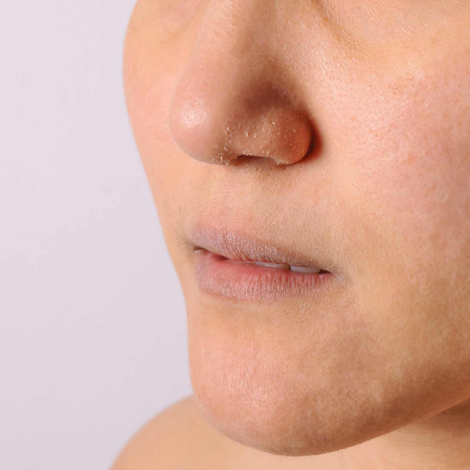 Dry Skin